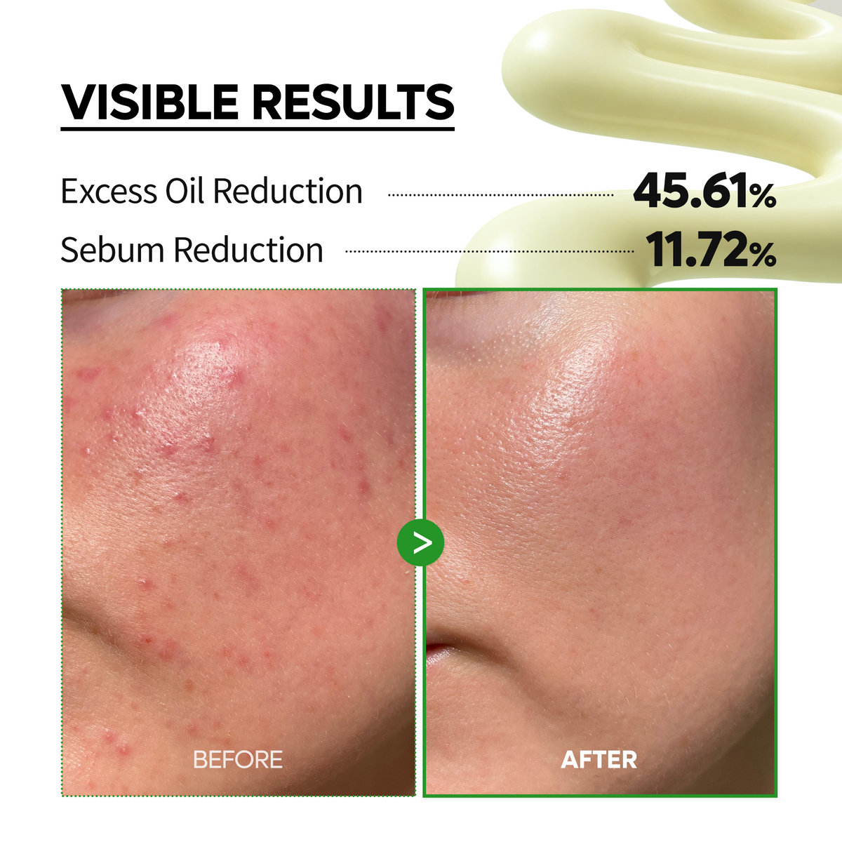 S-ZINC Blemish Cream