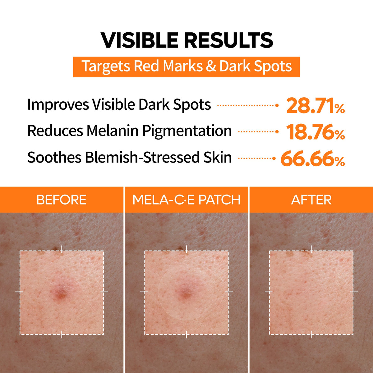 Trending Product | Zero-Fit Blemish & Dark Spot Patch Duo (144 Patches)