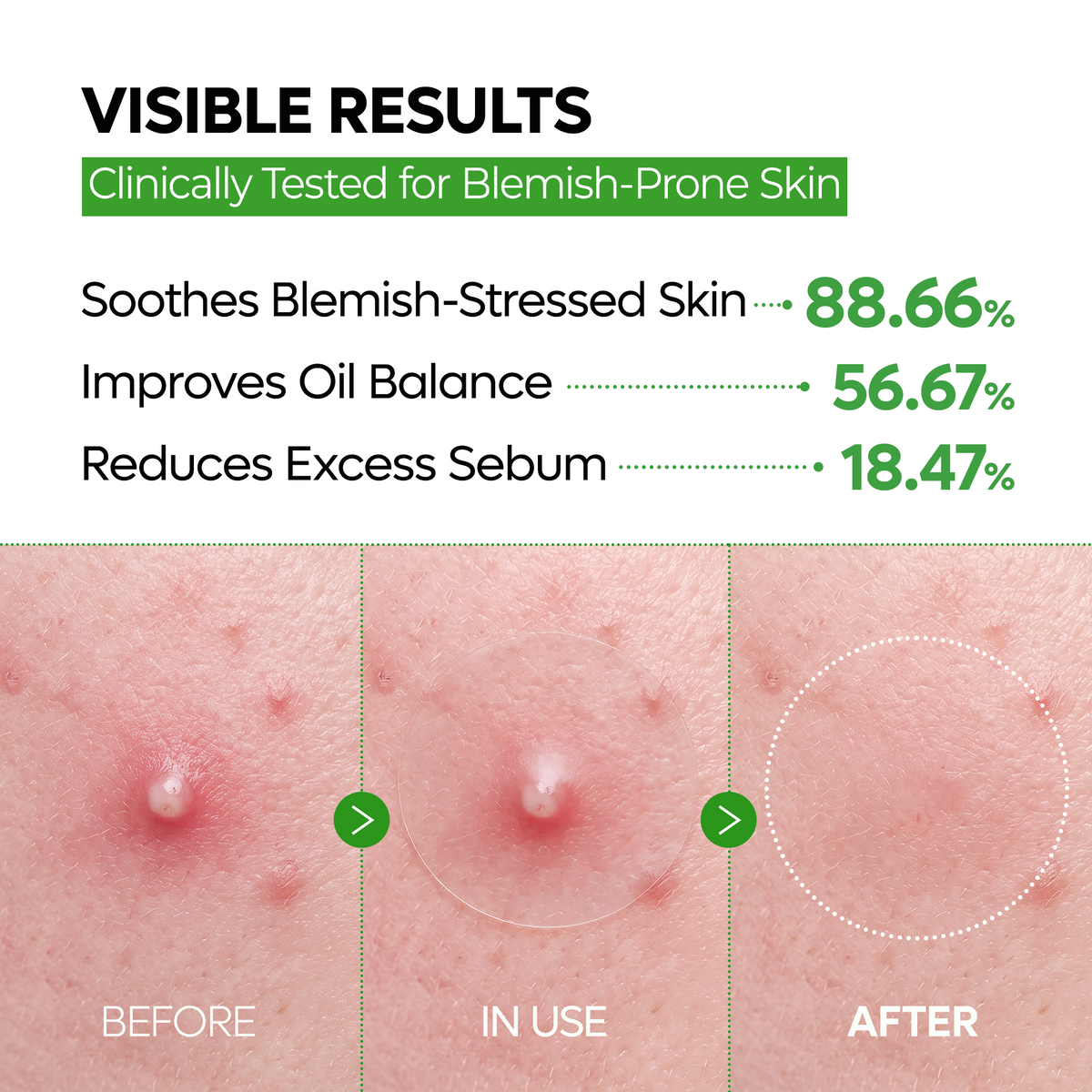 Trending Product | Zero-Fit Blemish & Dark Spot Patch Duo (144 Patches)